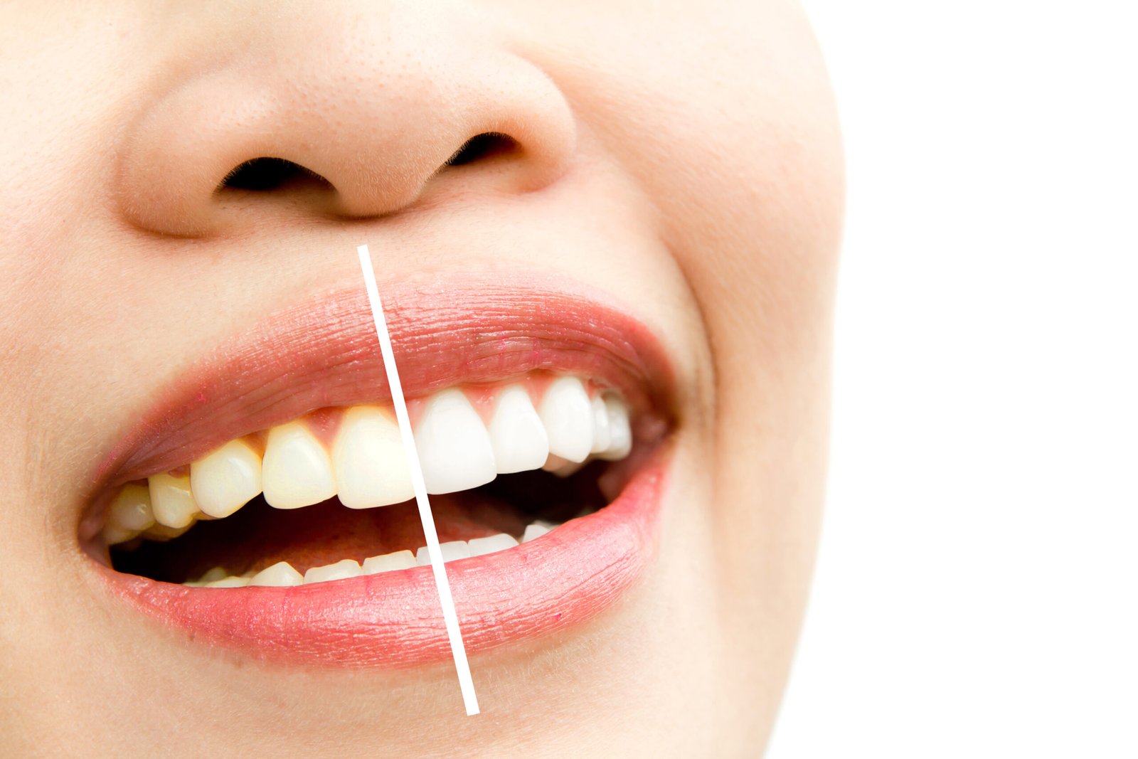 woman teeth before and after whitening. Over white background